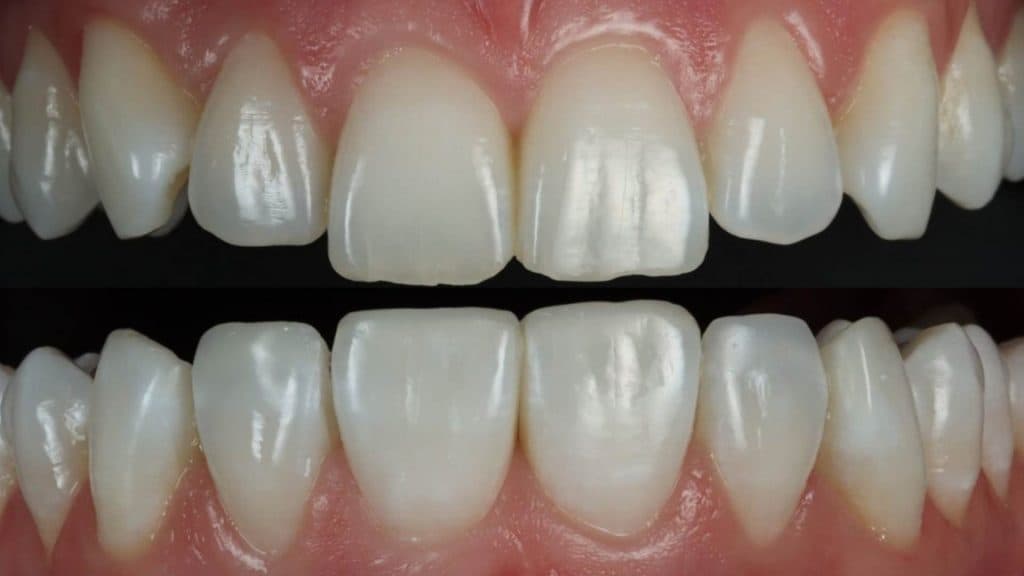 Composite Bonding