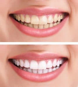 Cosmetic Dentistry