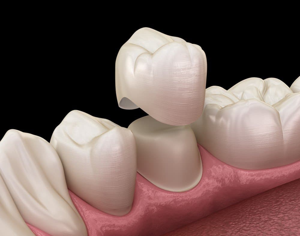 Ceramic Crowns