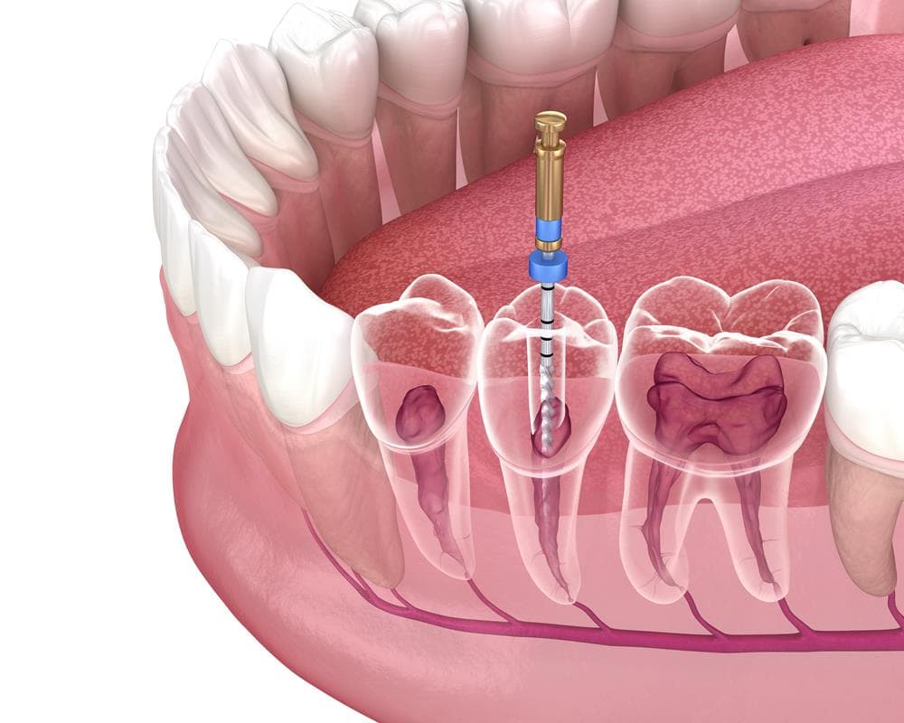 Root Canal Therapy