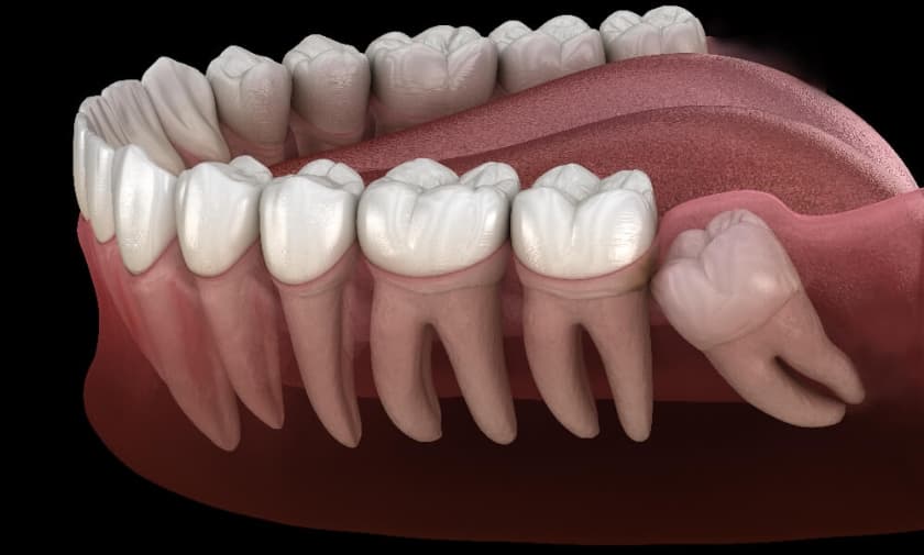 Wisdom Teeth Removal